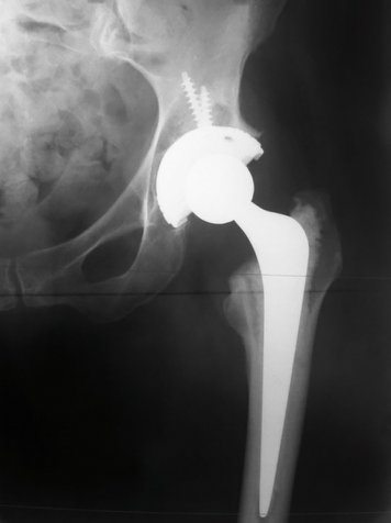 hip replacement 004.JPG