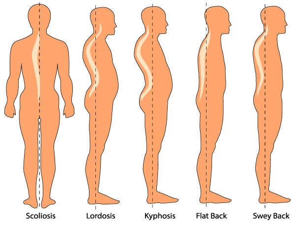 spinal-deformities-lumbar-lordosis.png